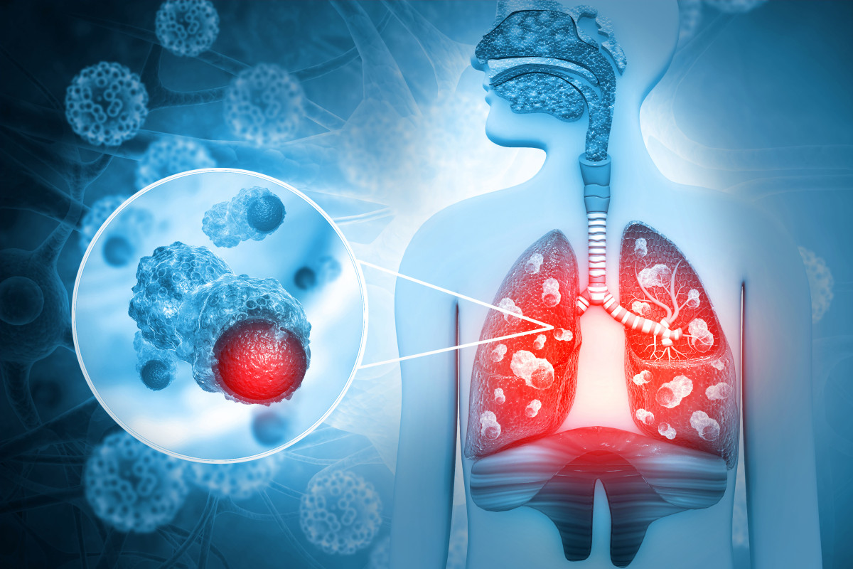 1 En cu00e1ncer de pulmu00f3n, la medicina de precisiu00f3n ha permitido determinar subtipos de la enfermedad y su perfil genu00f3mico e identificar nuevas terapias con objetivos claros