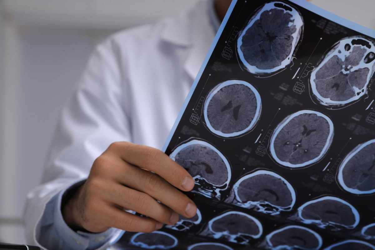 Detectan cambios en regiones cerebrales en individuos con alzheimer y alta carga patologica
