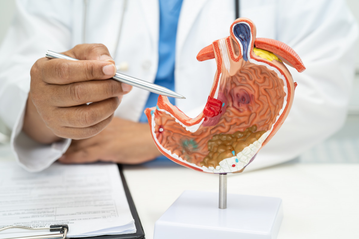 FOTO Cancer de Pancreas